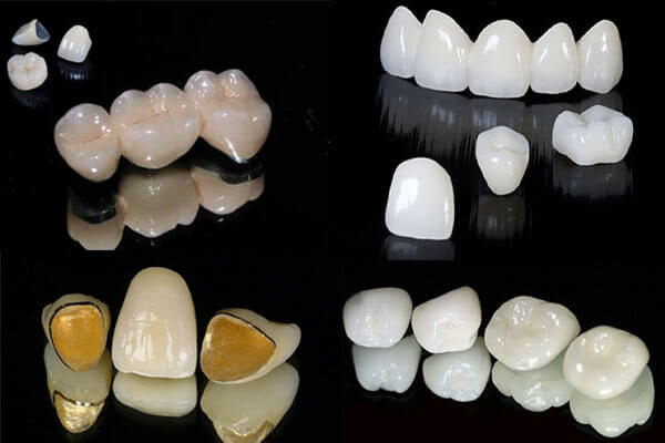 Tuổi thọ của từng loại răng sứ như thế nào?