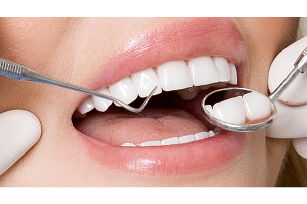 Tại sao cần chăm sóc sau khi bọc răng sứ
