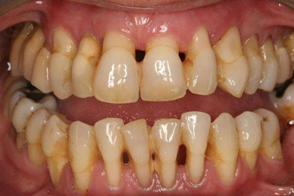 Vôi răng là nguyên nhân gây ra các bệnh về răng miệng