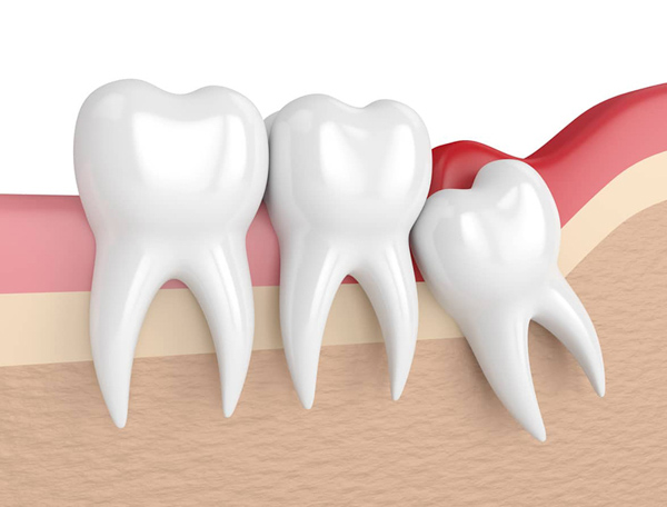 Răng khôn là loại răng số 8 mọc ở con người khi đạt đến độ tuổi trưởng thành