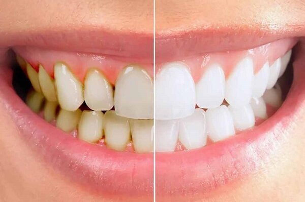 Cao răng hình thành thế nào?