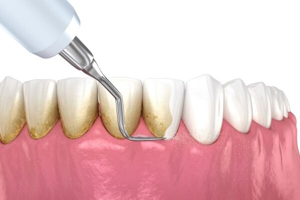 Lấy cao răng định kỳ để đảm bảo sức khỏe răng miệng