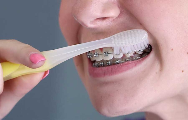 Đánh răng sai cách khiến niềng răng bị tụt lợi
