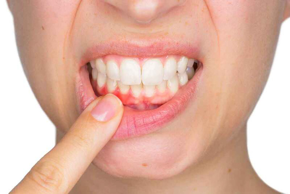Do những thói quen xấu khiến tụt lợi khi niềng răng