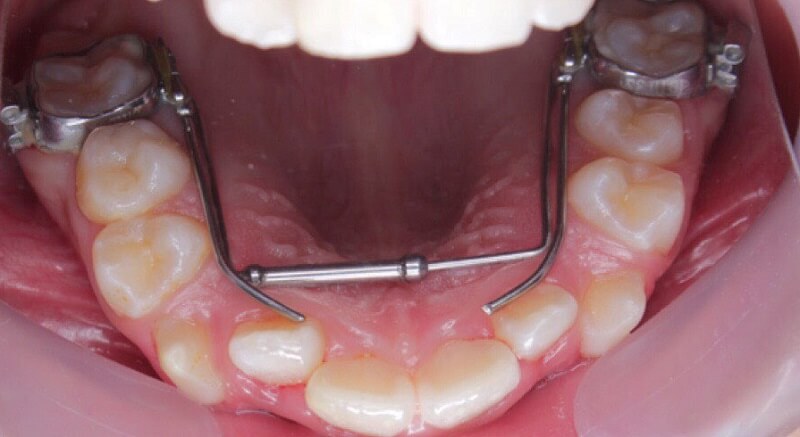 Không đủ diện tích để sắp xếp răng trong vòm hàm