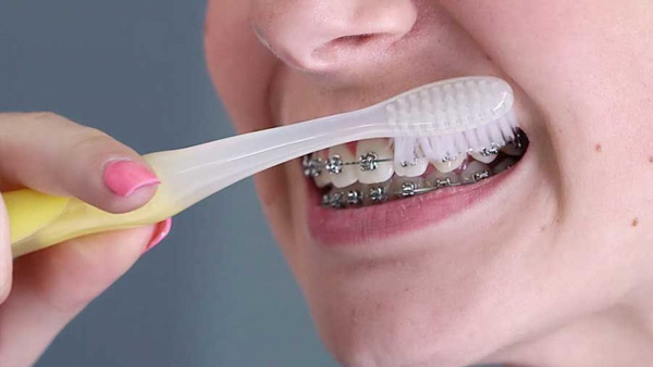 Đánh răng đúng cách khi niềng răng