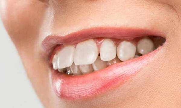 Răng hô làm răng hàm trên lệch ra ngoài so với hàm dưới.