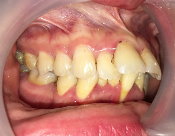 Răng hô khiến việc vệ sinh răng miệng khó khăn