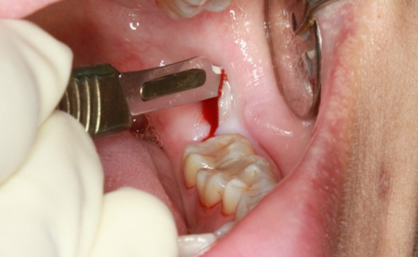 Nhổ răng khôn gây nguy hiểm gì không?