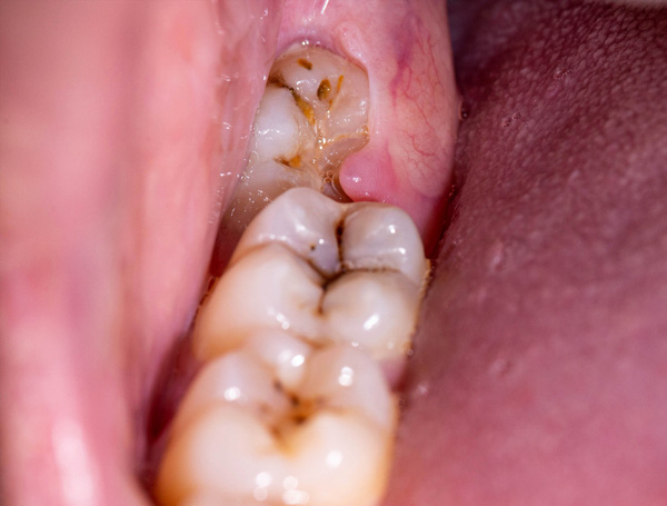 Răng khôn mọc lệch gây viêm chân răng