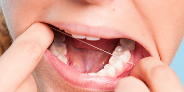 Răng khôn khó chăm sóc và vệ sinh nên dễ bị sâu răng
