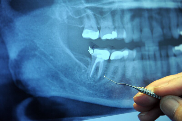 Phẫu thuật nhổ răng khôn một cách khá đơn giản và nhanh chóng