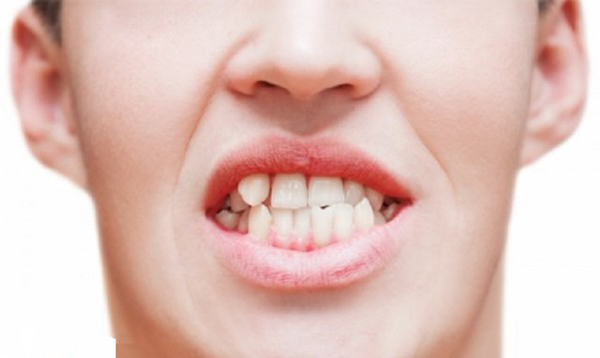 Khả năng nhai kém vì răng mọc chồi