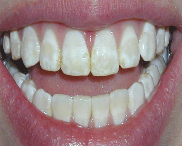 Răng nhiễm fluor như thế nào?