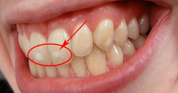 Dấu hiệu nhận biết răng nhiễm fluor nhẹ