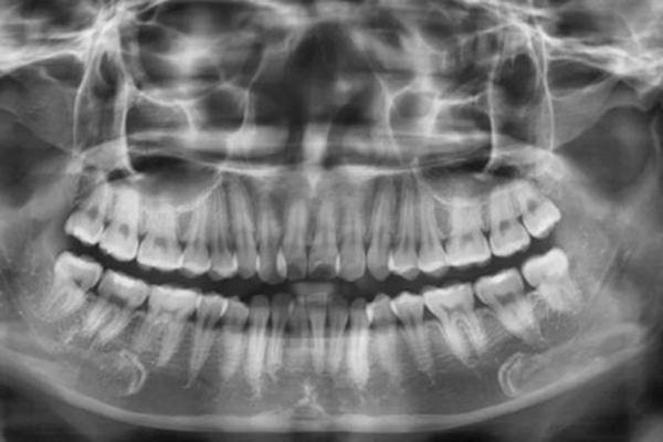 Chụp X Quang răng