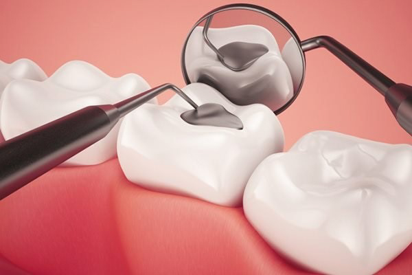 Quy trình trám răng trực tiếp diễn ra như thế nào?