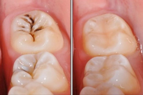 Răng sâu nên trám để bảo vệ răng miệng tốt hơn