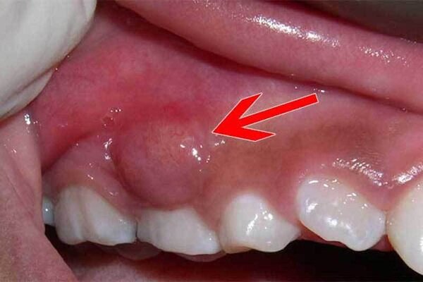 Dấu hiệu áp xe chân răng
