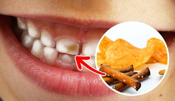 Hạn chế tiếp xúc với các món gây hại cho răng