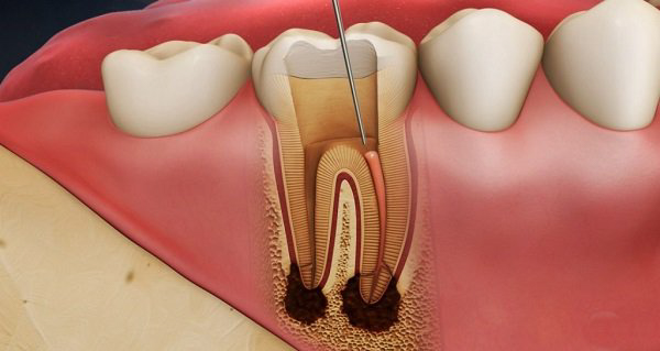 Tại sao cần phải điều trị tủy răng càng sớm càng tốt?