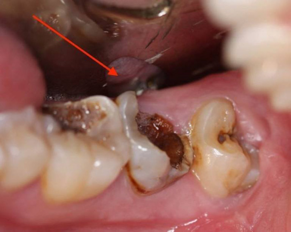 Giai đoạn viêm tủy răng bị hoại tử