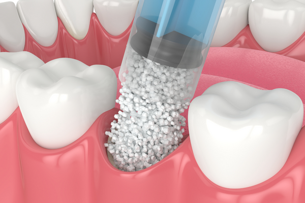 Khi nào cần ghép xương răng?