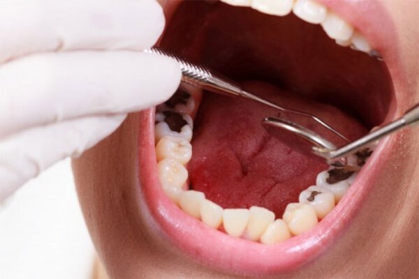 Hàm răng có thể gây đau trong một số trường hợp.
