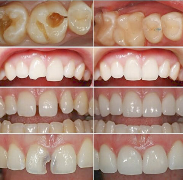 Hàn răng sâu giúp răng trở nên chắc khoẻ và thẩm mỹ hơn.