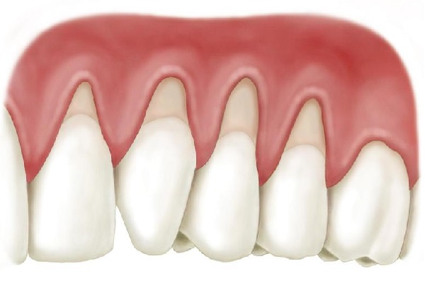 2 cách điều trị hở chân răng phổ biến