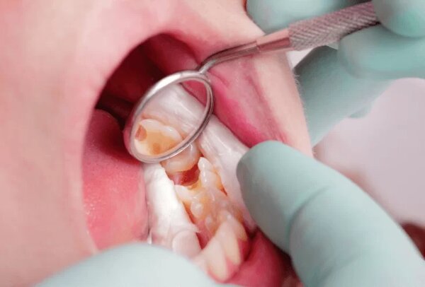 Chăm sóc răng miệng thật kỹ sau khi lấy tủy răng