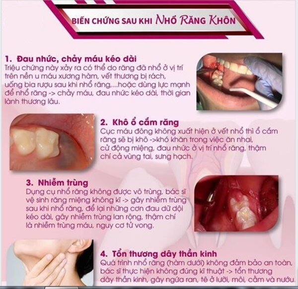 Những biến chứng có thể xảy ra sau khi nhổ răng.