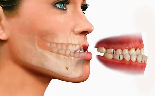 Tình trạng răng móm