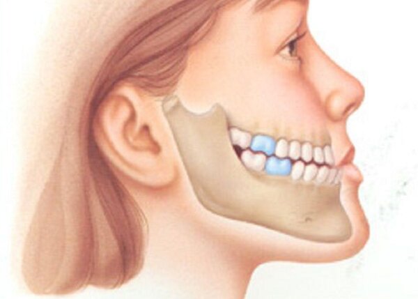Dấu hiệu của răng móm