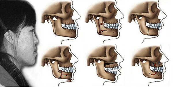 Răng móm ảnh hưởng rất nhiều đến khuôn mặt