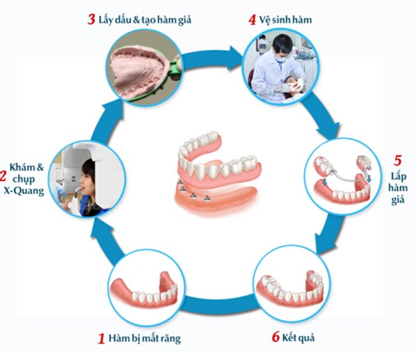 Quy trình thực hiện tháo lắp răng giả rất an toàn và đạt tiêu chuẩn y tế