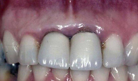Cách khắc phục răng sứ titan bị đen hiệu quả