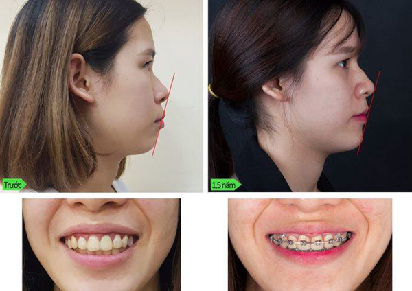 Trước và sau khi điều trị răng vẩu