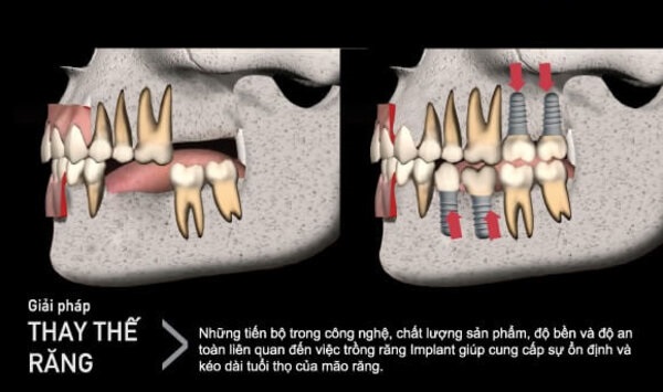 Tiêu xương hàm có nhiều ảnh hưởng đến việc trồng răng Implant.