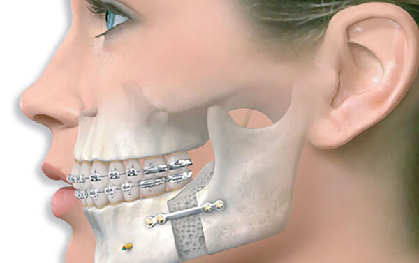Phẫu thuật chỉnh hàm giúp bệnh nhân có khung xương hàm chắc khỏe.