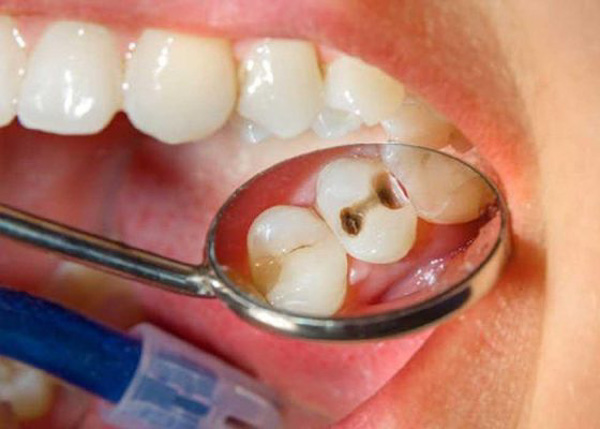 Răng có thể bị sâu lại sau khi trám