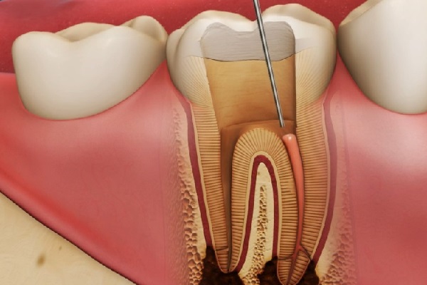 3 nguyên nhân gây ra răng chết tủy