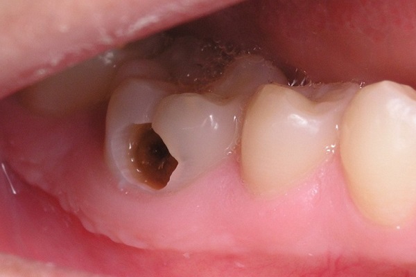 Các giai đoạn răng chết tủy