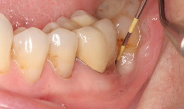 Tìm hiểu về viêm chân răng là gì?