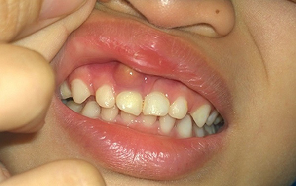 Rối loạn miễn dịch gây viêm chân răng