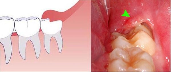 Viêm lợi trùng là một loại bệnh phổ biến xảy ra ở những người chăm sóc răng miệng không đúng cách