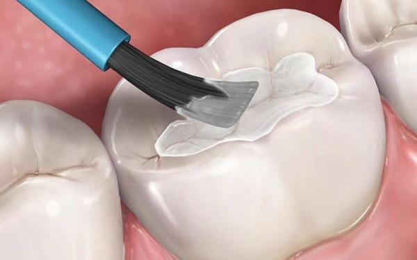Trám răng tại nhà chỉ là giải pháp tạm thời không thể thay thế điều trị tại nha sĩ