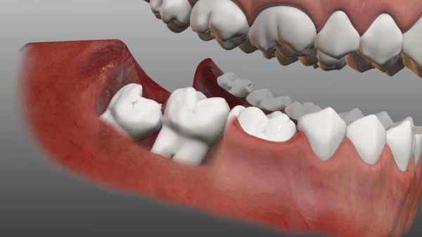 Răng khôn mọc lệch 45 độ có thể gây ra nhiều vấn đề về sức khỏe răng miệng và đau đớn