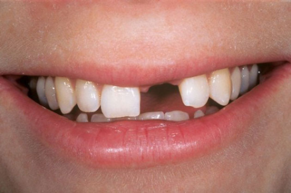 Gãy răng cửa là một trong những vấn đề về răng khá phổ biến