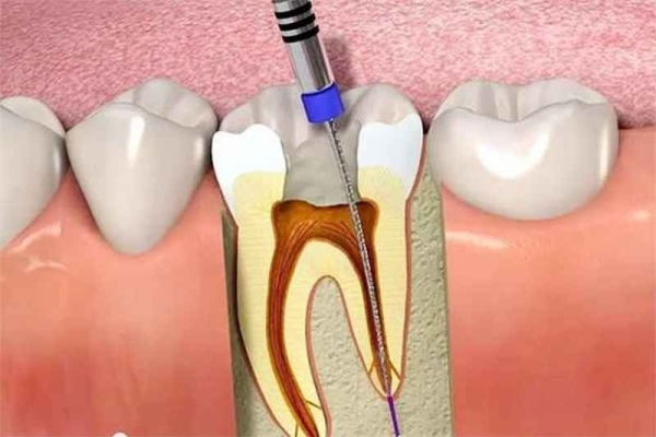 Lấy tủy răng là một quá trình y tế được thực hiện để loại bỏ toàn bộ dây thần kinh, mô liên kết và các tạp chất trong răng và nên lấy tủy răng mấy lần thì an toàn
